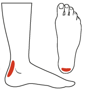 Achilles Tendinitis